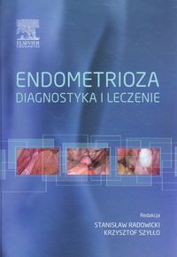 Endometrioza diagnostyka i leczenie